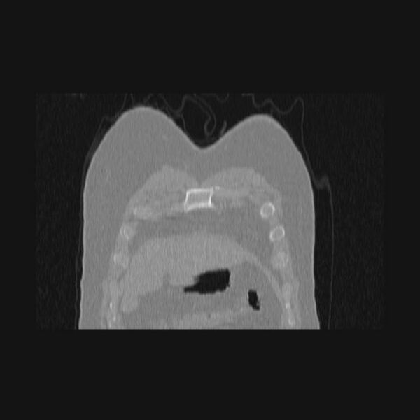 File:Bronchial atresia (Radiopaedia 60685-68439 Coronal lung window 73).jpg