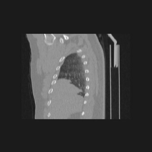 File:Bronchial atresia (Radiopaedia 60685-68439 Sagittal lung window 10).jpg