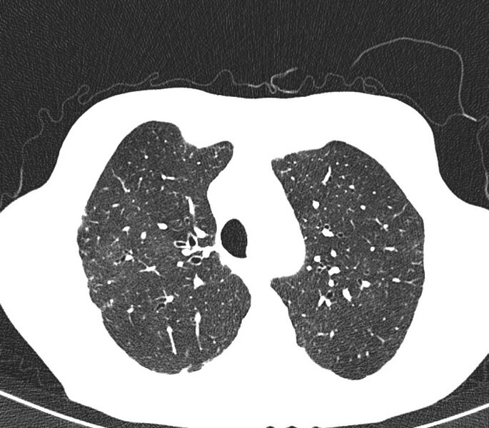 File:Bronchiolitis (Radiopaedia 24616-24887 Axial lung window 12).jpg