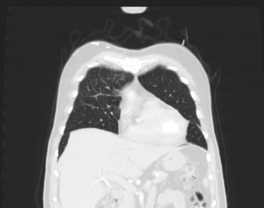 Bronchogenic carcinoma with lymphangitic spread (Radiopaedia 29002-29357 Coronal lung window 13).jpg