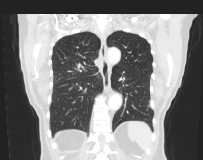 Bronchogenic carcinoma with lymphangitic spread (Radiopaedia 29002-29357 Coronal lung window 50).jpg