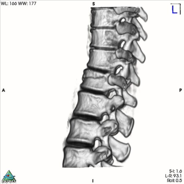 File:Bulging of paraspinal line in traumatic thoracal spinal compression fracture (Radiopaedia 29221-35872 3D VR 23).jpg