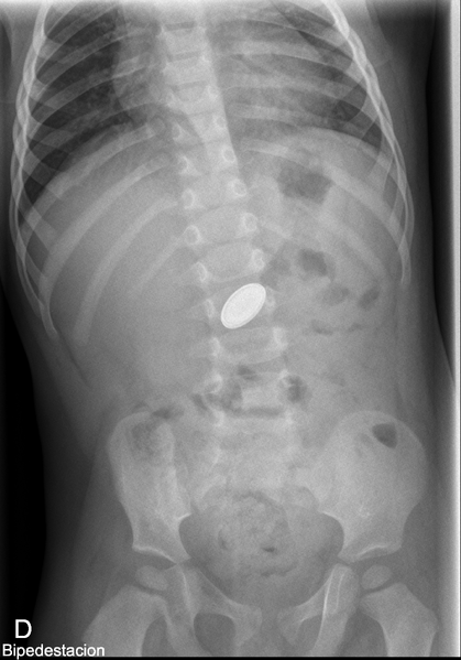 File:Button battery ingestion (Radiopaedia 30986-31681 Frontal 1).png