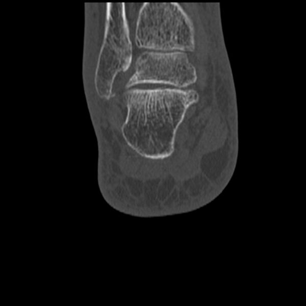 File:Calcaneal tuberosity avulsion fracture (Radiopaedia 22649-22668 Coronal bone window 54).jpg
