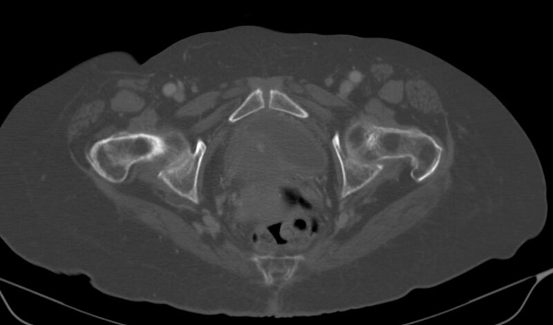 File:Calcified fibroids (Radiopaedia 20306-20228 Axial bone window 24).jpg