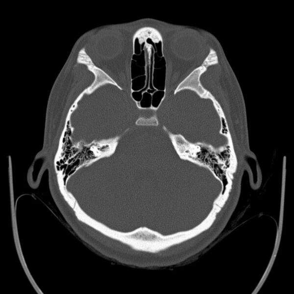 File:Calvarial osteoma (Radiopaedia 36520-38079 Axial bone window 31).jpg