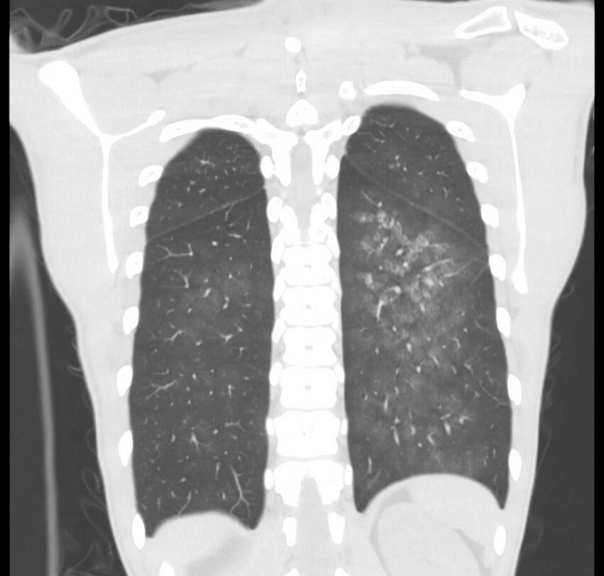 Cannabis-induced diffuse alveolar hemorrhage (Radiopaedia 89834-106946 Coronal lung window 18).jpg