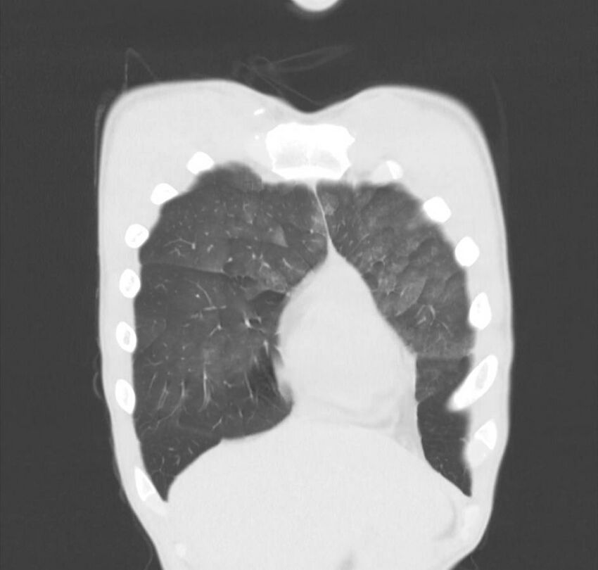 Cannabis-induced diffuse alveolar hemorrhage (Radiopaedia 89834-106946 Coronal lung window 76).jpg