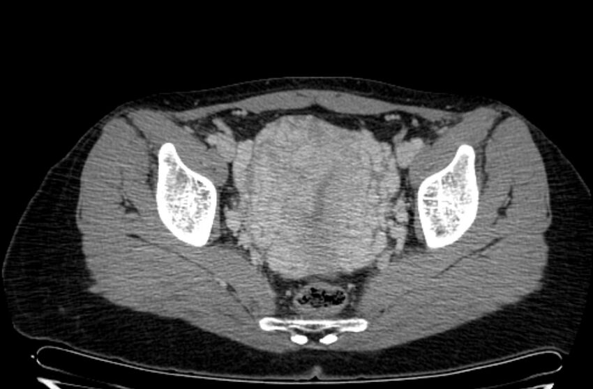 Cannonball metastases - uterine choriocarcinoma (Radiopaedia 70137-80174 A 29).jpg