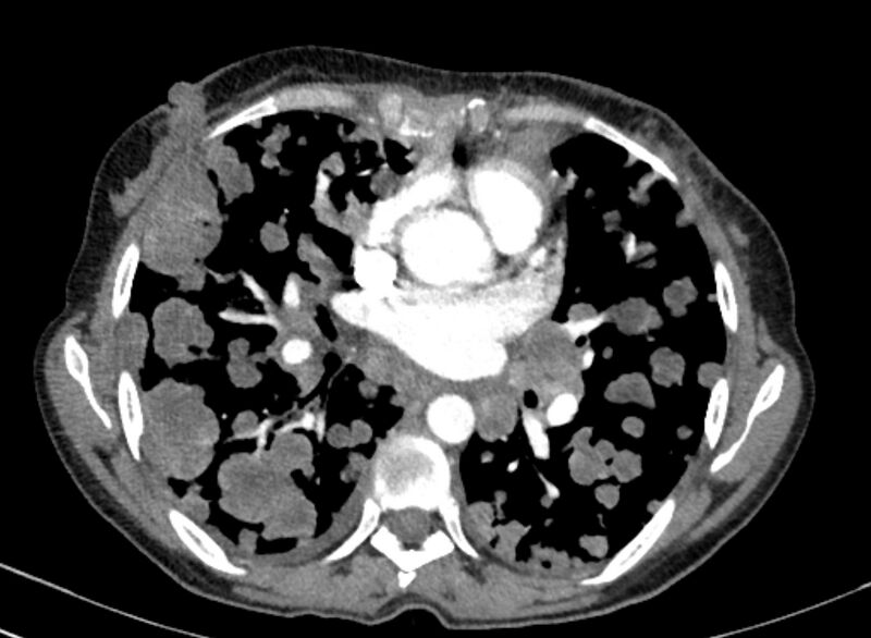 File:Cannonball metastases from breast cancer (Radiopaedia 91024-108569 A 65).jpg