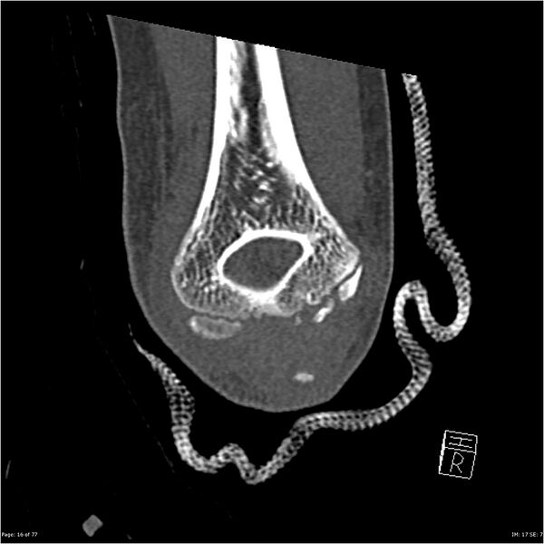 File:Capitellum fracture (Radiopaedia 23352-23426 Coronal bone window 16).jpg