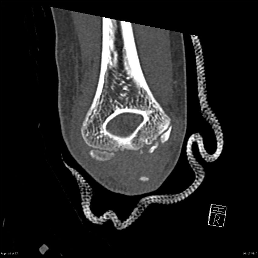 Capitellum fracture (Radiopaedia 23352-23426 Coronal bone window 16).jpg