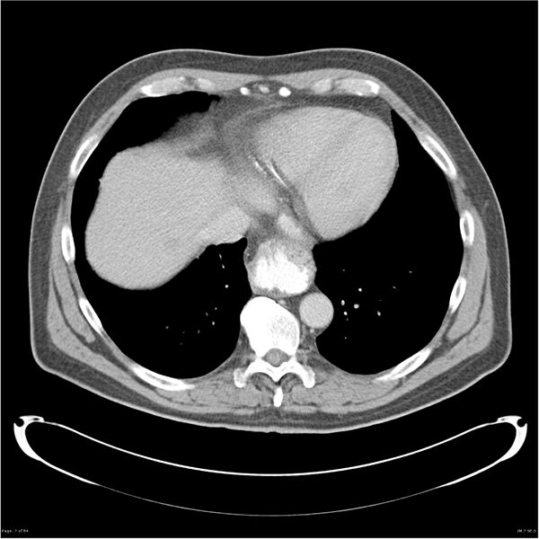 File:Carcinoid tumor (Radiopaedia 26918).jpg