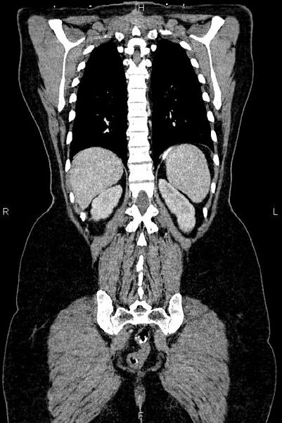 File:Carcinoma of uterine cervix (Radiopaedia 85861-101700 C 46).jpg