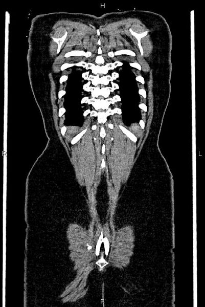 File:Carcinoma of uterine cervix (Radiopaedia 85861-101700 C 55).jpg