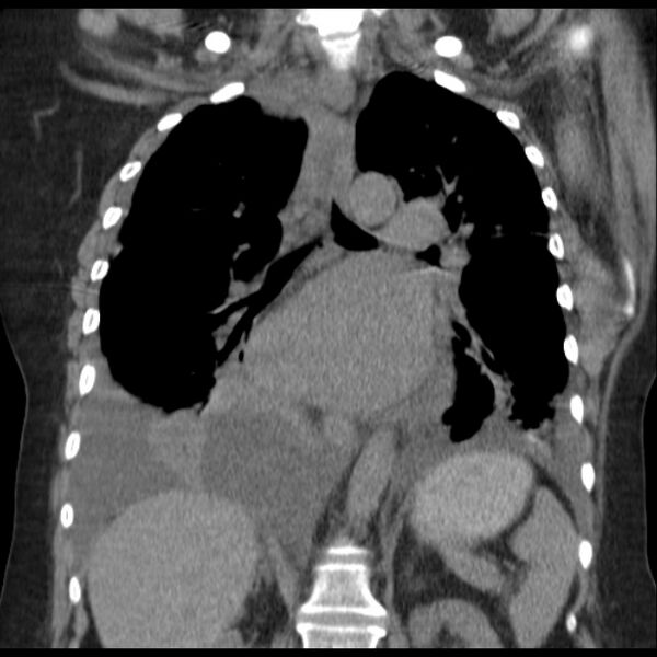 File:Cardiogenic pulmonary edema (Radiopaedia 29213-29609 Coronal non-contrast 25).jpg