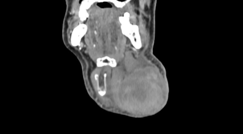 File:Carotid artery pseudoaneurysm (Radiopaedia 84030-99259 D 12).jpg