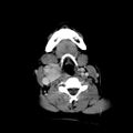 Carotid body tumor (Radiopaedia 27890-28124 A 18).jpg