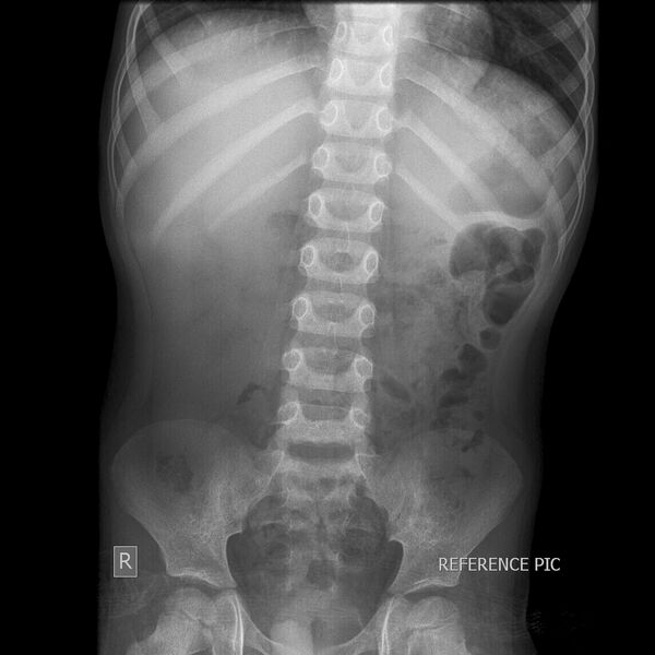 File:Caustic esophageal stricture (Radiopaedia 67290-76661 Control film 1).JPEG