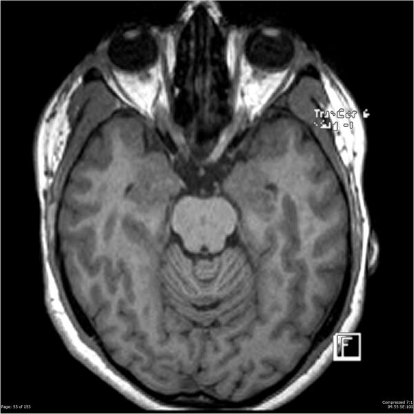 File:Cavernous malformation (cavernous angioma or cavernoma) (Radiopaedia 36675-38237 Axial T1 44).jpg