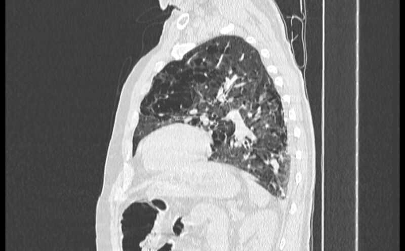 File:Cavitating bronchogenic carcinoma (Radiopaedia 44489-48162 Sagittal lung window 47).jpg