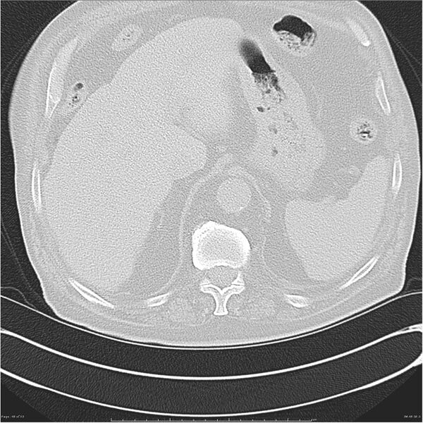 File:Cavitating left lower lobe lesion - squamous cell lung cancer (Radiopaedia 27749-28176 Axial lung window 48).jpg