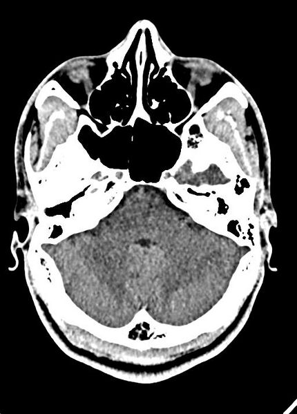 File:Cavum septum pellucidum and cavum vergae (Radiopaedia 77797-90060 Axial Brain Window 25).jpg