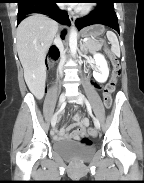 File:Cecum hernia through the foramen of Winslow (Radiopaedia 46634-51112 B 26).png
