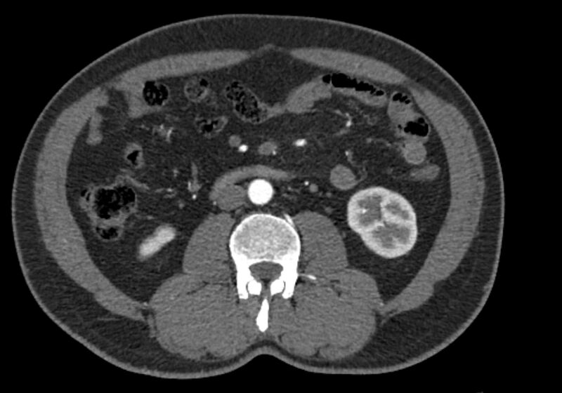 File:Celiac artery dissection (Radiopaedia 52194-58080 A 55).jpg