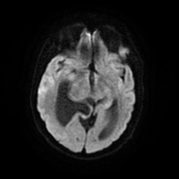 File:Central neurocytoma (Radiopaedia 67618-77021 Axial DWI 9).jpg