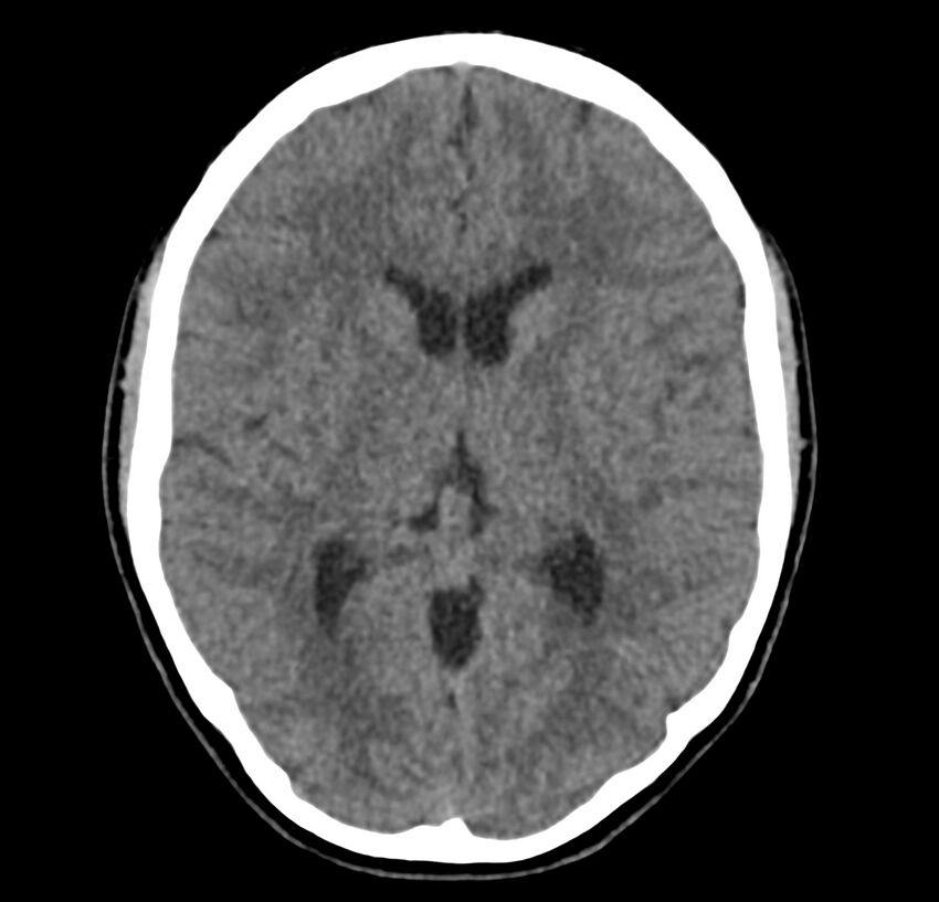 Cerebellar agenesis (Radiopaedia 30203-30817 Axial non-contrast 24).jpg