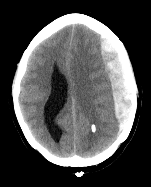 File:Cerebellar ependymoma complicated by post-operative subdural hematoma (Radiopaedia 83322-97737 Axial non-contrast 12).png