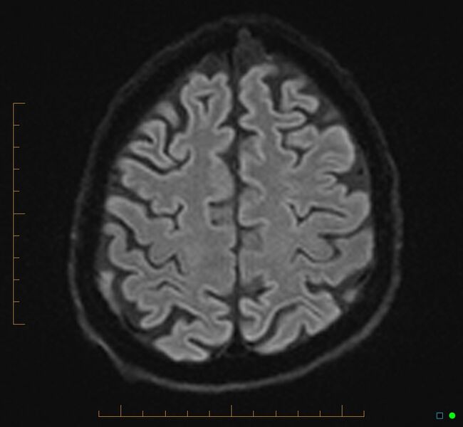 File:Cerebellar gangliocytoma (Radiopaedia 65377-74422 Axial DWI 31).jpg