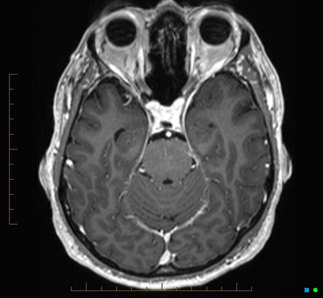 File:Cerebellar gangliocytoma (Radiopaedia 65377-74422 Axial T1 C+ 41).jpg
