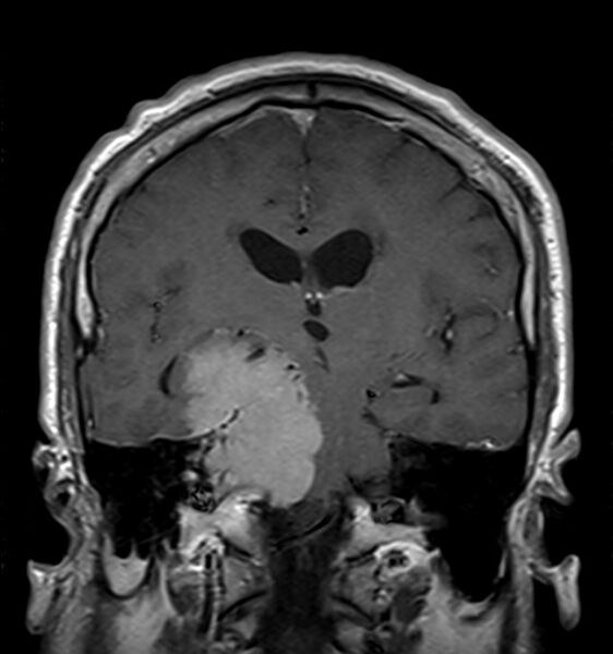 File:Cerebellopontine angle meningioma (Radiopaedia 24459-24764 Coronal T1 C+ 12).jpg