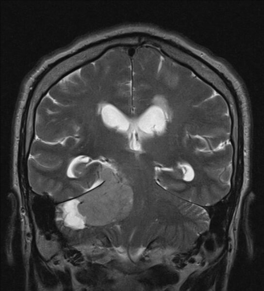 File:Cerebellopontine angle meningioma (Radiopaedia 24459-24764 Coronal T2 15).jpg