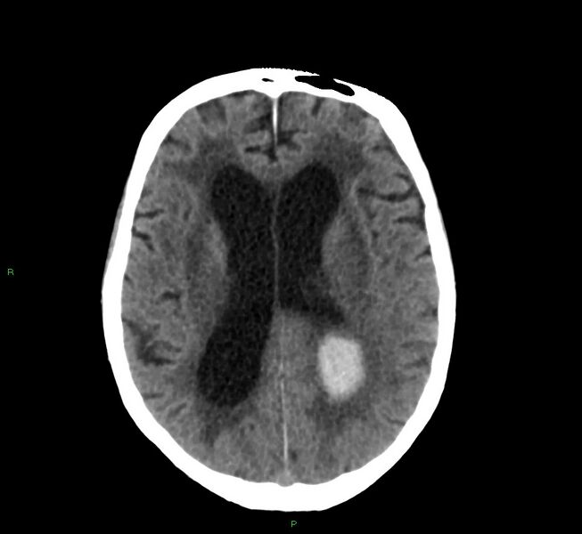 File:Cerebral amyloid angiopathy-associated lobar intracerebral hemorrhage (Radiopaedia 58530-65688 Axial non-contrast 21).jpg