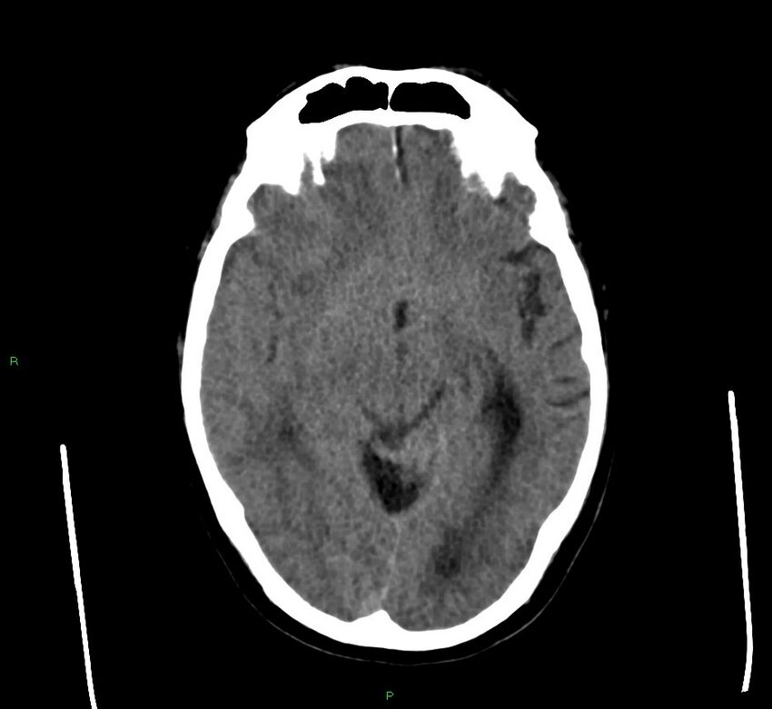 Cerebral amyloid angiopathy-associated lobar intracerebral hemorrhage (Radiopaedia 58560-65723 Axial non-contrast 32).jpg