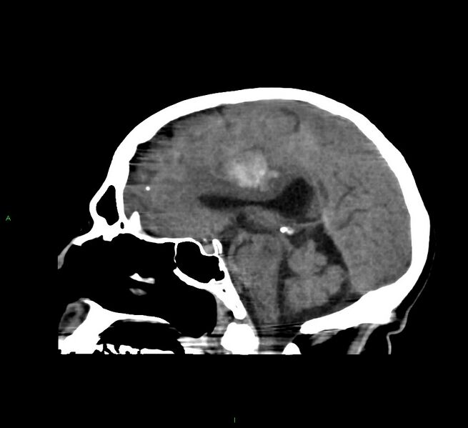 File:Cerebral amyloid angiopathy-associated lobar intracerebral hemorrhage (Radiopaedia 58560-65723 C 27).jpg
