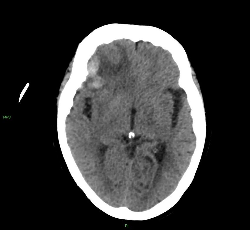 Cerebral amyloid angiopathy-associated lobar intracerebral hemorrhage (Radiopaedia 58569-65734 Axial non-contrast 35).jpg