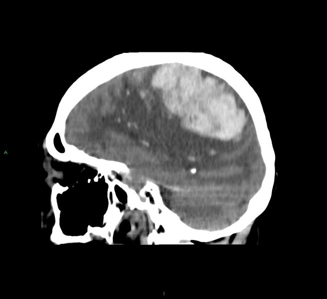 File:Cerebral amyloid angiopathy-associated lobar intracerebral hemorrhage (Radiopaedia 58751-65972 C 23).jpg