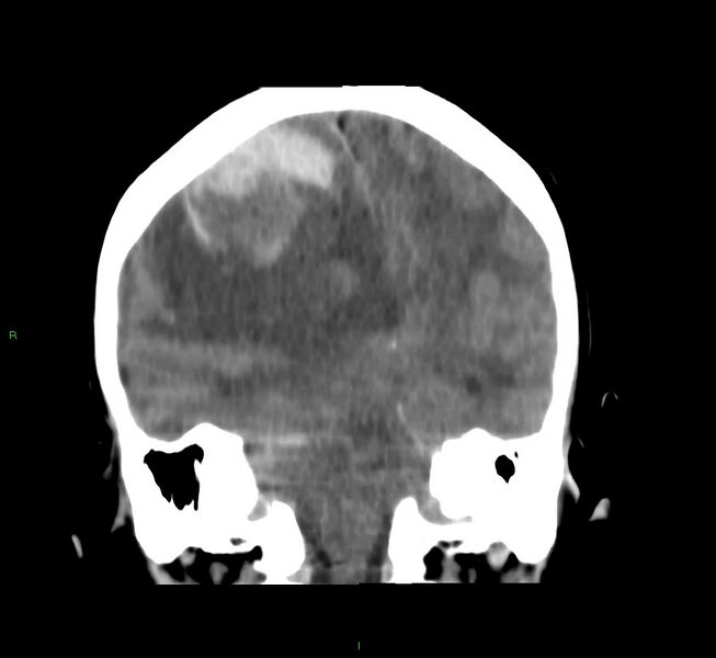 File:Cerebral amyloid angiopathy-associated lobar intracerebral hemorrhage (Radiopaedia 58751-65972 Coronal non-contrast 28).jpg