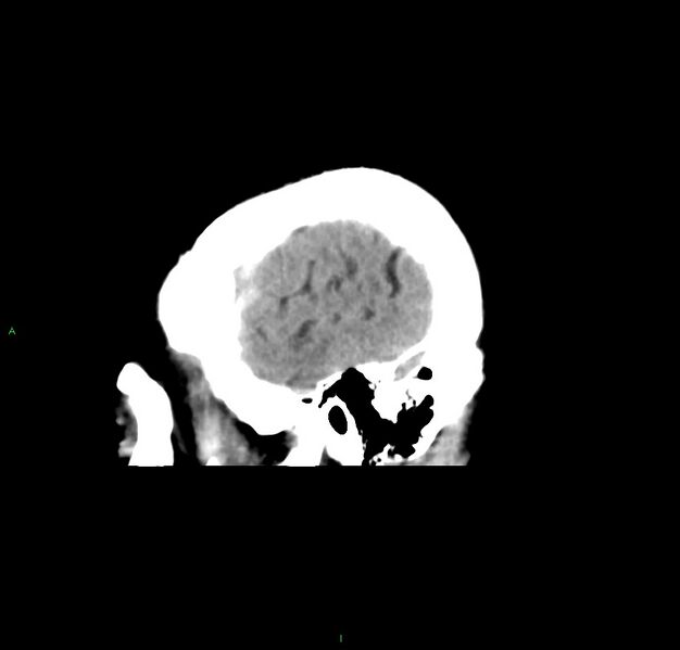 File:Cerebral amyloid angiopathy-associated lobar intracerebral hemorrhage (Radiopaedia 59356-66716 C 10).jpg