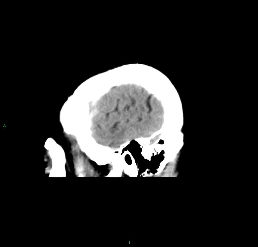 Cerebral amyloid angiopathy-associated lobar intracerebral hemorrhage (Radiopaedia 59356-66716 C 10).jpg