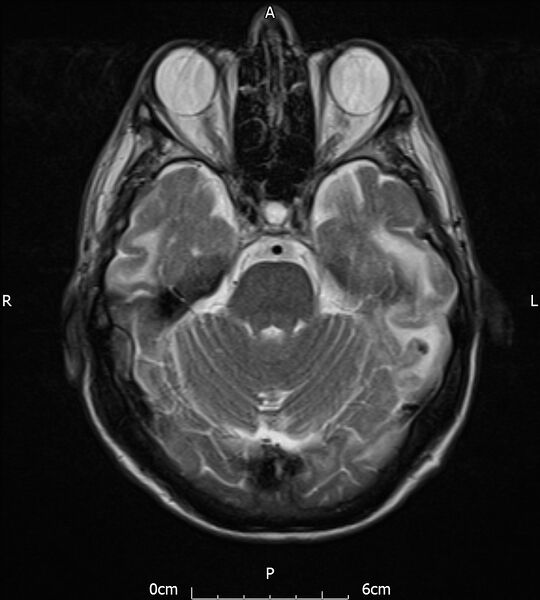 File:Cerebral amyloid angiopathy related inflammation (Radiopaedia 72772-83415 Axial T2 8).jpg