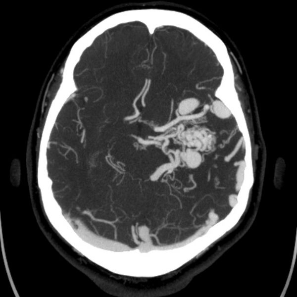 File:Cerebral arteriovenous malformation (Radiopaedia 43729-47189 B 21).jpg