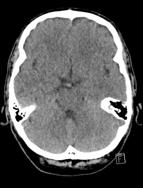 File:Cerebral arteriovenous malformation (Radiopaedia 78188-90745 Axial non-contrast 8).jpg