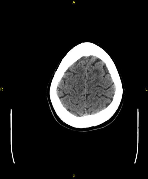 File:Cerebral autosomal dominant arteriopathy with subcortical infarcts and leukoencephalopathy (CADASIL) (Radiopaedia 86108-102051 Axial non-contrast 98).jpg