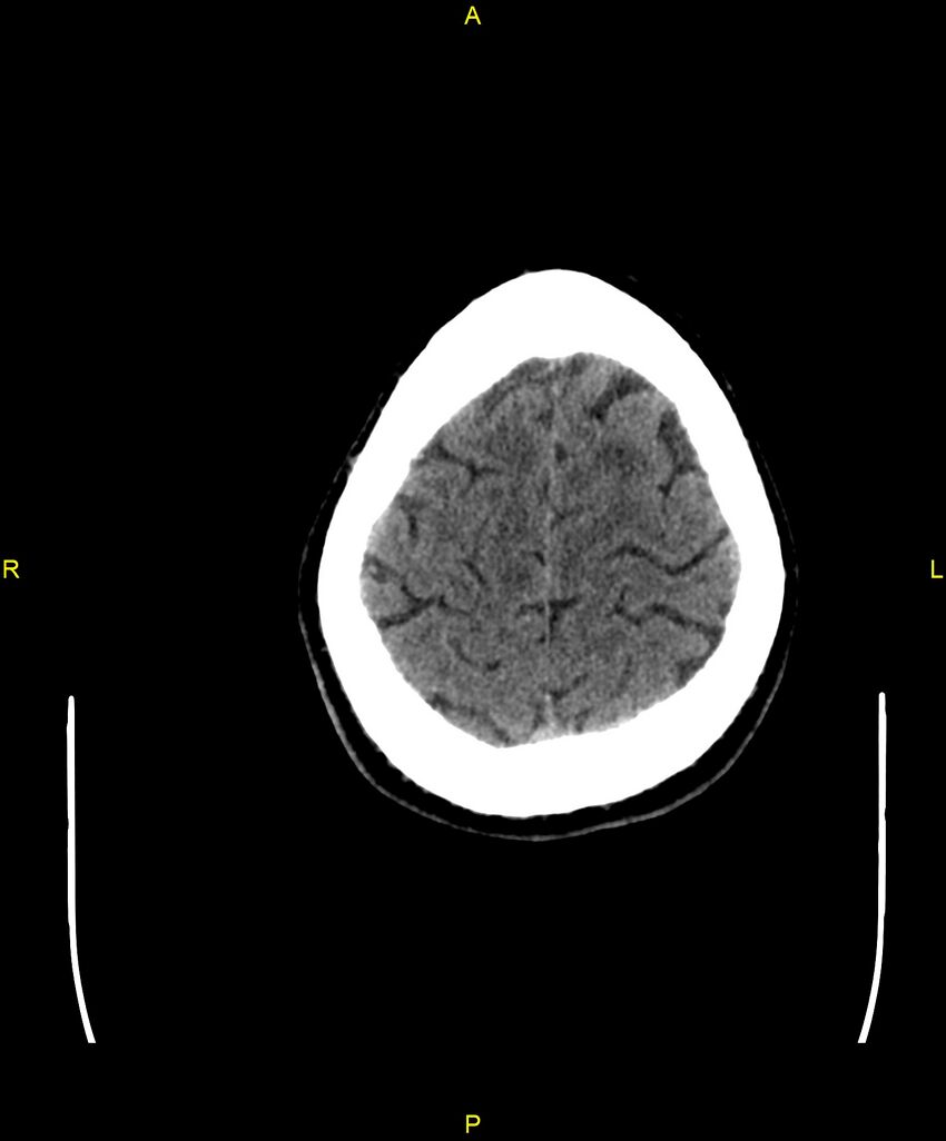 Cerebral autosomal dominant arteriopathy with subcortical infarcts and leukoencephalopathy (CADASIL) (Radiopaedia 86108-102051 Axial non-contrast 98).jpg