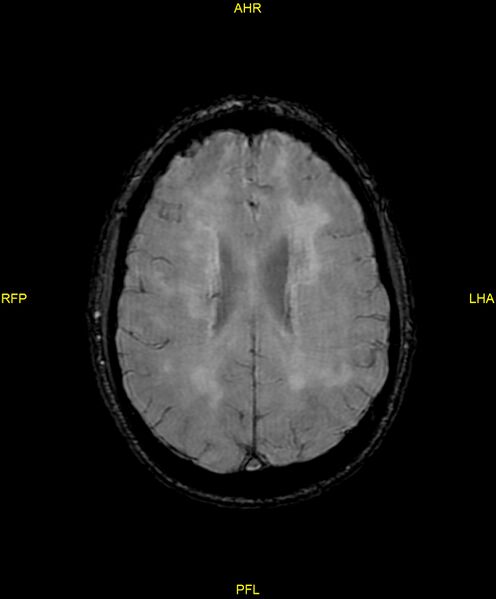 File:Cerebral autosomal dominant arteriopathy with subcortical infarcts and leukoencephalopathy (CADASIL) (Radiopaedia 86108-102054 Axial SWI 71).jpg